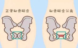 右侧耻骨是哪里（右侧耻骨骨折三个月了，还是不能走路，是什么原因）