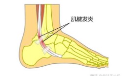 腓骨在哪里（腓骨部位有隐痛状况）