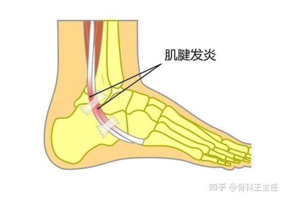 腓骨在哪里（腓骨部位有隐痛状况）-图1