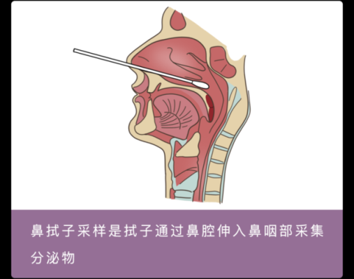 做鼻哪里好（请问：武汉核酸检测为什么有的是抽血，有的是咽喉取样，有的是鼻腔取样）-图2