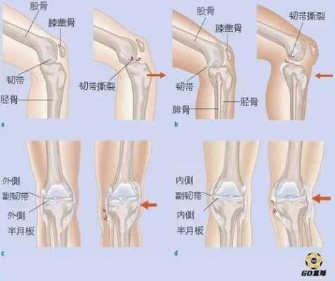 膝盖韧带在哪里（膝盖韧带在哪里）-图2