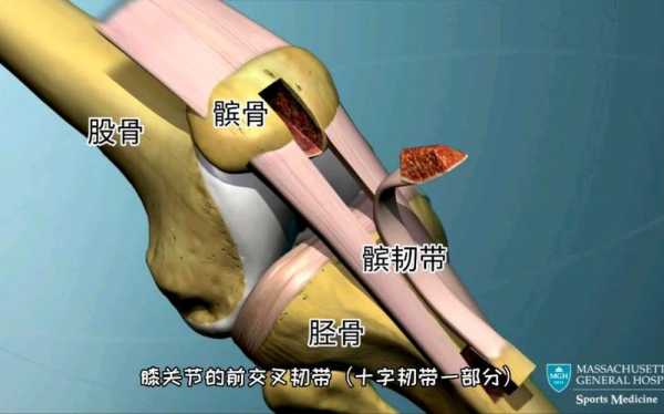 十字韧带断裂选什么韧带重建,十字韧带在哪里图片-图1