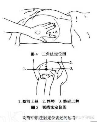 肌肉注射是打哪里（肌肉注射是打哪里的部位）-图3