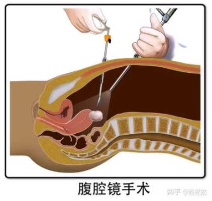 腹腔镜子宫切除手术怎样取出子宫,子宫切除从哪里开刀图-图1