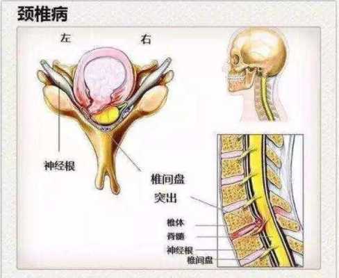 颈椎病是哪里痛（颈椎病哪里痛图解）-图2