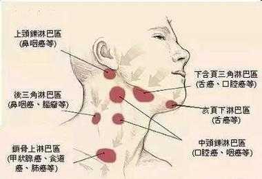 颌下淋巴结肿大的原因是什么,淋巴结肿大怎么消除 颌下-图2