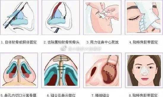 隆鼻的方法有哪些呢,哪里的隆鼻手术好-图2