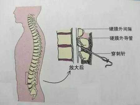 全麻在哪里打麻醉针（麻醉很痛吗？只是睡一觉吗）-图3