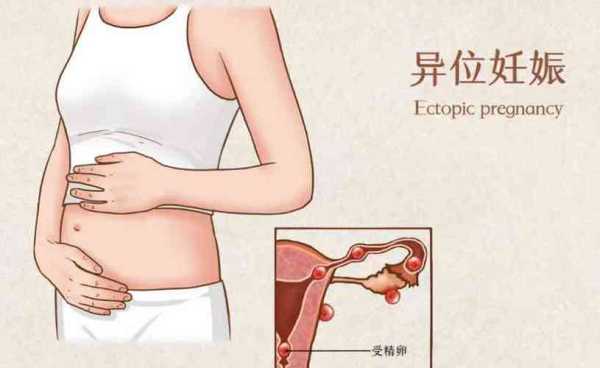 宫外孕疼痛位置是哪里,宫外孕是哪里疼图解-图2