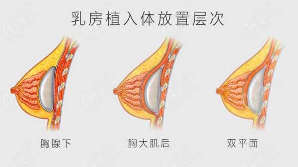 哪里隆胸技术最好（隆胸好吗）-图1