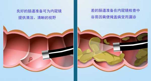 肠镜插哪里（肠镜插哪里的）-图2