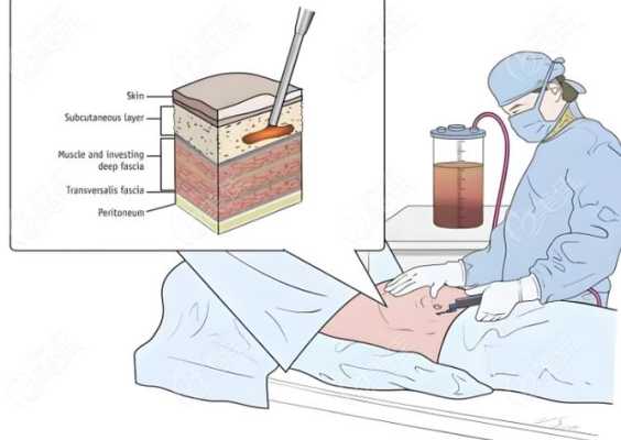 哪里抽脂技术好（哪里抽脂技术好）-图1