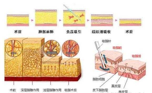 哪里抽脂技术好（哪里抽脂技术好）-图2