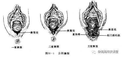 顺产剪哪里（产妇顺产时，自然撕裂和侧切有什么不同）-图3