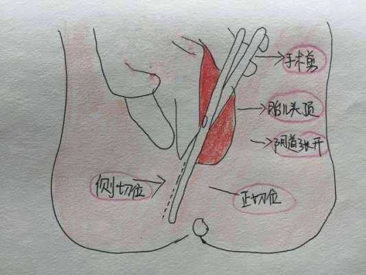 顺产剪哪里（产妇顺产时，自然撕裂和侧切有什么不同）-图2