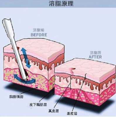 抽脂肪去哪里了（抽脂肪去哪里了好）-图3