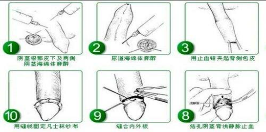 哪里能割包皮（哪里割包皮好）-图1