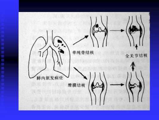 肺结核哪里痛（如何区分骨结核带来的腰腿疼痛）-图3