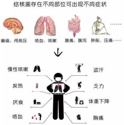 肺结核哪里痛（如何区分骨结核带来的腰腿疼痛）-图1