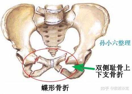 右侧耻骨是哪里（右侧耻骨骨折三个月了，还是不能走路，是什么原因）-图2