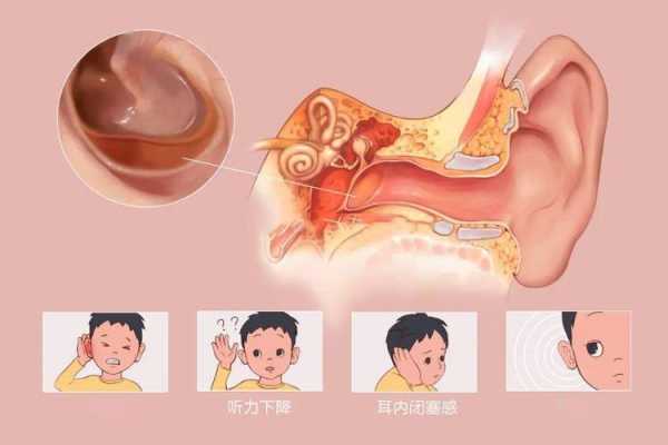 中耳炎对是身体会造成哪些危害,宁波耳鼻喉科哪里好一点-图1