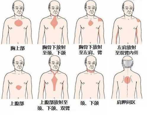 胸闷在哪里（胸闷在哪里）-图1