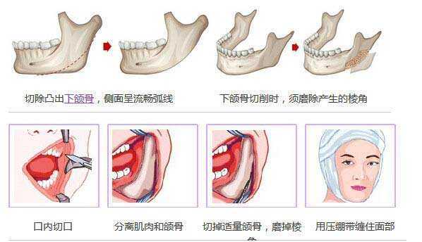 磨颧骨从哪里开刀（改脸型手术的方法有哪些）-图3