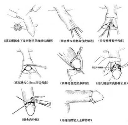 沈阳割包皮哪里好（龟头下面的冠状沟有什么作用）-图1