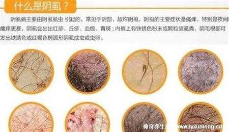 阴虱是哪里痒（阴虱是哪里痒 里边还是外边）-图1