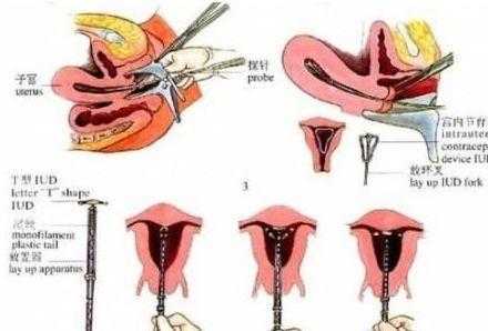 避孕环哪个好,上环去什么地方上?-图2