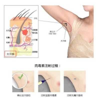 哪里可以去除腋臭（哪里可以去除腋臭的方法）-图1