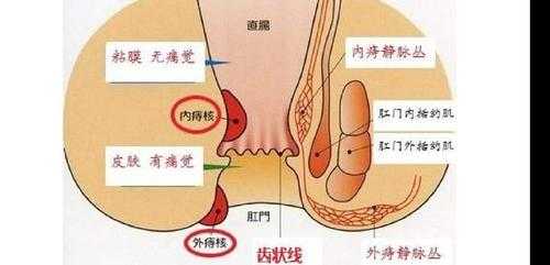 痔疮在哪里长着（痔疮在哪里长着呢图片）-图1