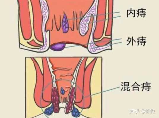 痔疮在哪里长着（痔疮在哪里长着呢图片）-图2