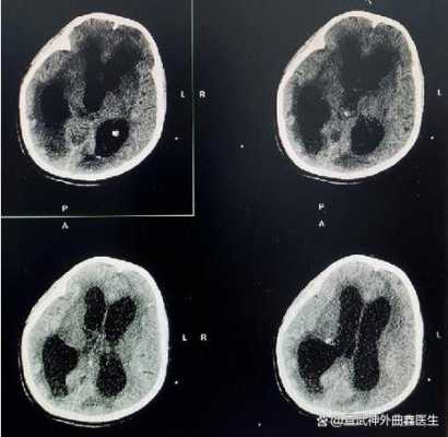 哪里治疗脑积水最好（哪里治疗脑积水最好的医院）-图1