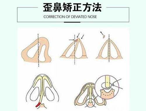 哪里做歪鼻纠正手术（哪里做歪鼻纠正手术）-图1