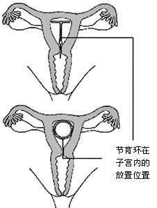 节育环放在子宫哪里（节育环放在子宫哪里）-图1